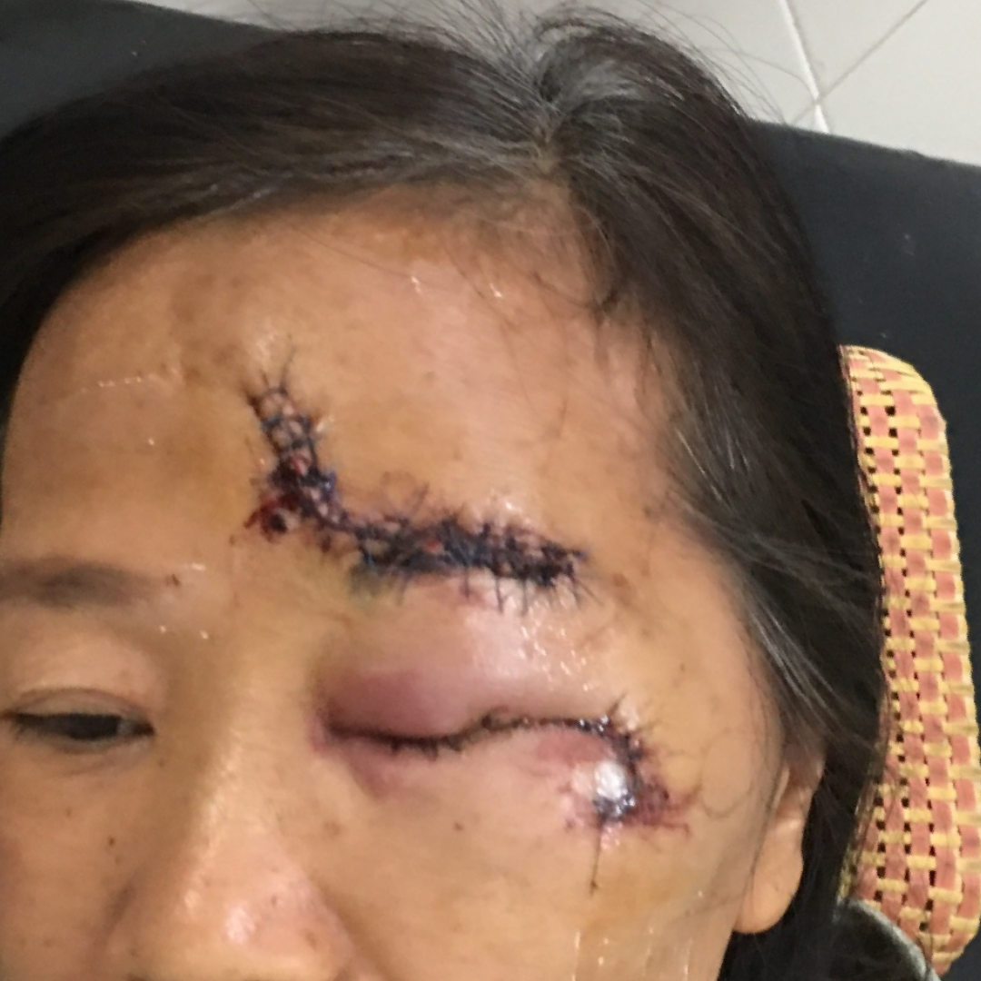 Hình ảnh trước chăm sóc ca lâm sàng 03